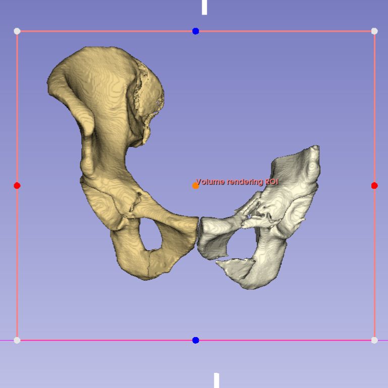 3D Slicer — Hemipelvis frontal